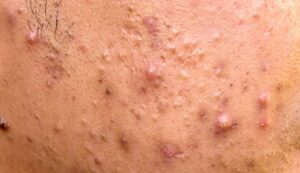 22905 acne papules