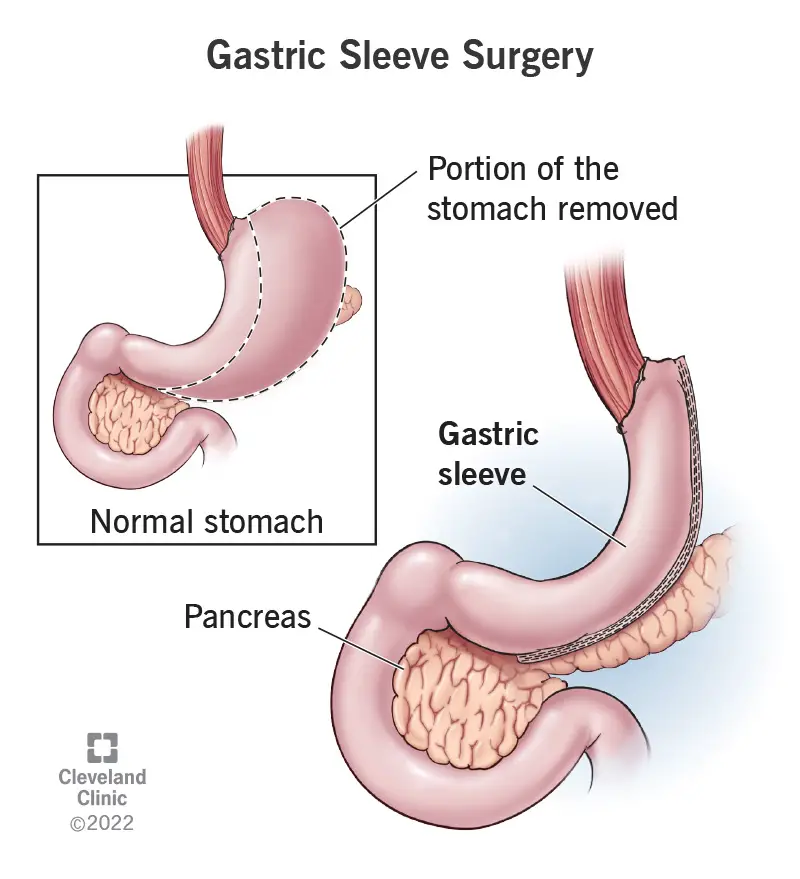 22931 gastric sleeve surgery