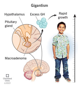 22954 gigantism