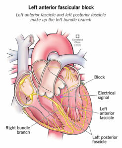 23212 left anterior fascicular block