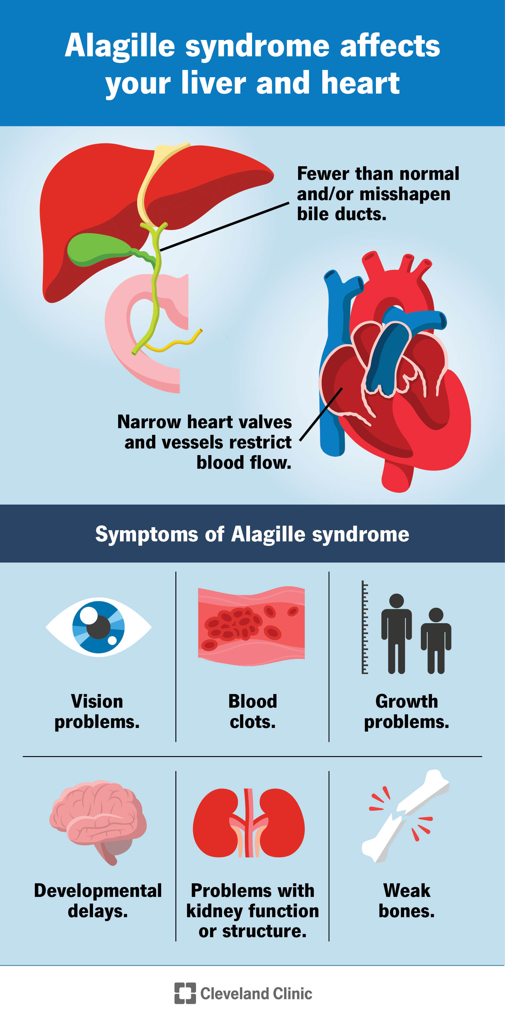 Alagille sindromas paveikia jūsų širdį ir kepenis ir sukelia kitus simptomus visame kūne.