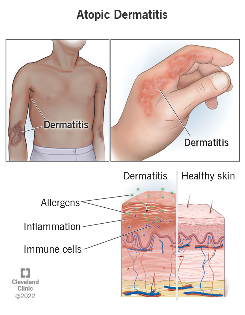 Atopinio dermatito bėrimai ant žmogaus rankos, rankos ir šono su odos palyginimu su bėrimu ir be jo.