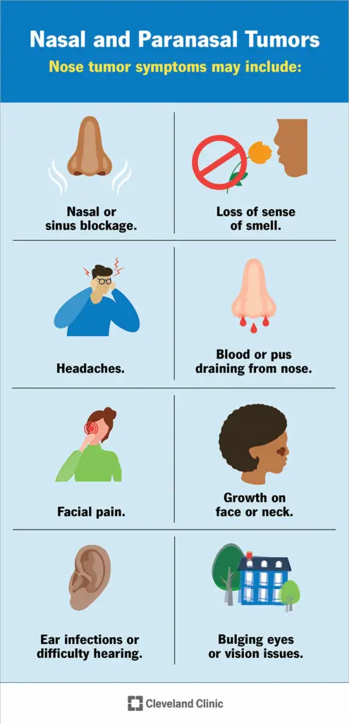 24927 nasal paranasal tumors