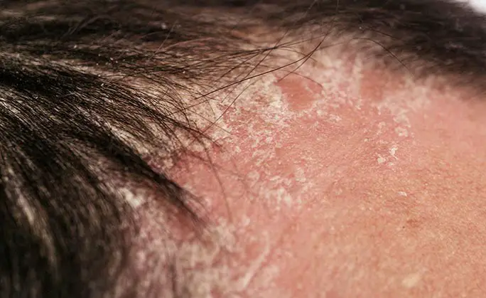 25047 facial psoriasis