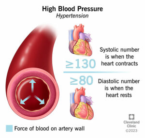 4314 high blood pressure illustration