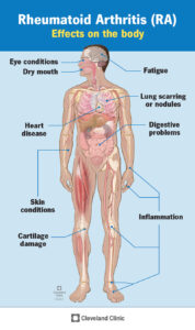 4924 rheumatoid arthritis 2