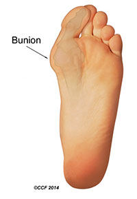 Pėdos iliustracija: Bunion