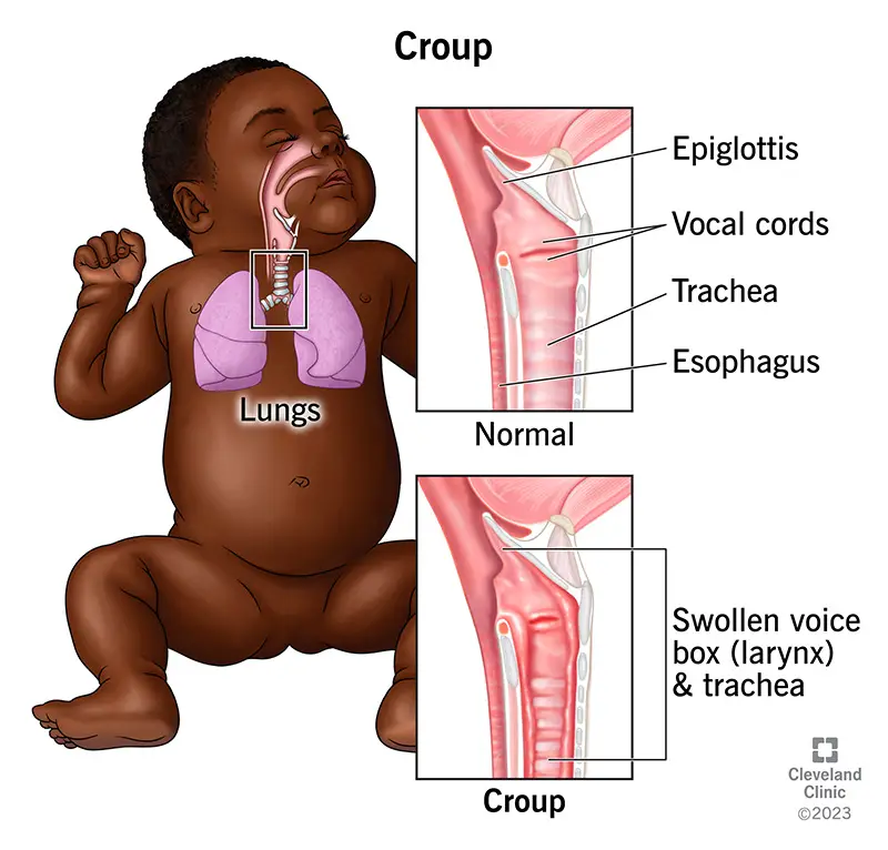 8277 croup