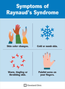 9849 raynauds syndrome