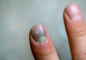 FingernailBruise 1227060560 770x533 1 jpg