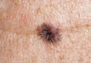 Melanoma 155131938770x533 1 jpg