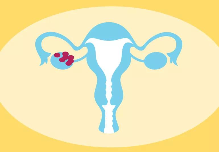 PCOS uterusOvaries 883164360 770x533 1 jpg