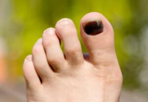 blackToenails 497274351 770x533 1 jpg