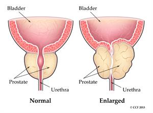 normali ir padidėjusi prostata