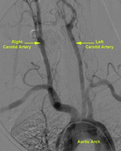 Miego arterijos anatomija su angiografija