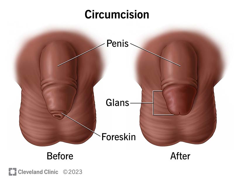 circumcision