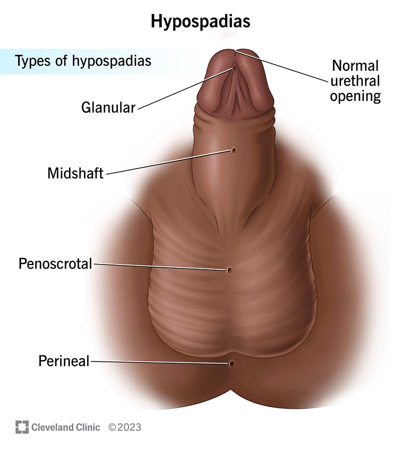 hypospadias