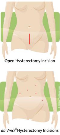 incision comparison da vinci