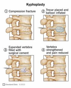 kyphoplasty