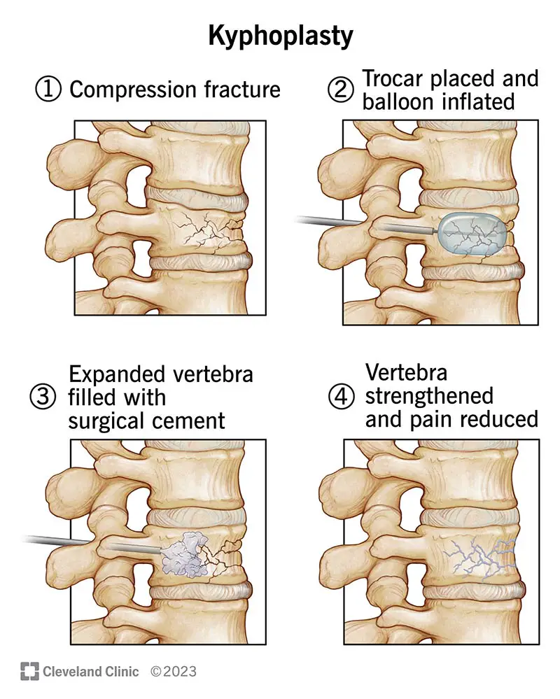 kyphoplasty