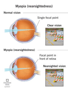 myopia nearsightedness