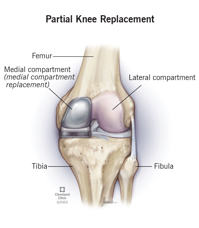 partial knee replacement