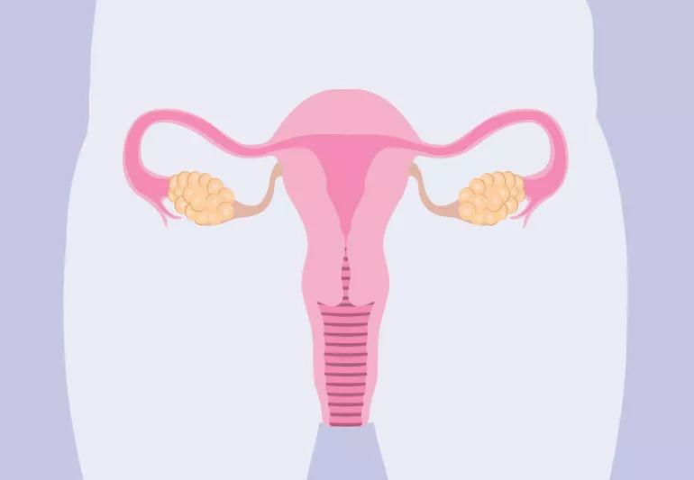 pcos uterusOvaries 1169701391 770x533 1 jpg