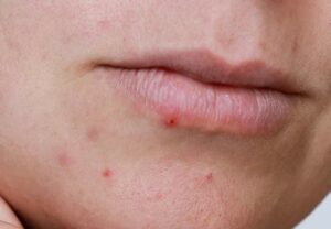 pimple On Lip 1438535565 770x533 1 jpg