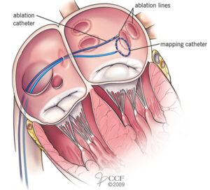 pvai procedure.ashx