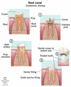 root canal