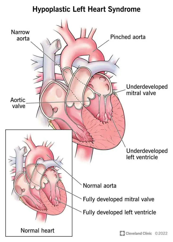 12214 hypoplastic left heart syndrome