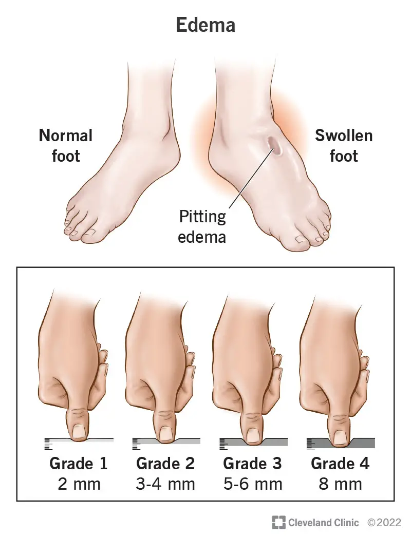 Edema yra patinimas, kurį sukelia skysčių kaupimasis.  Jūsų paslaugų teikėjas atliks patinusios srities duobių testą.