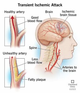 14173 transient ischemic attack