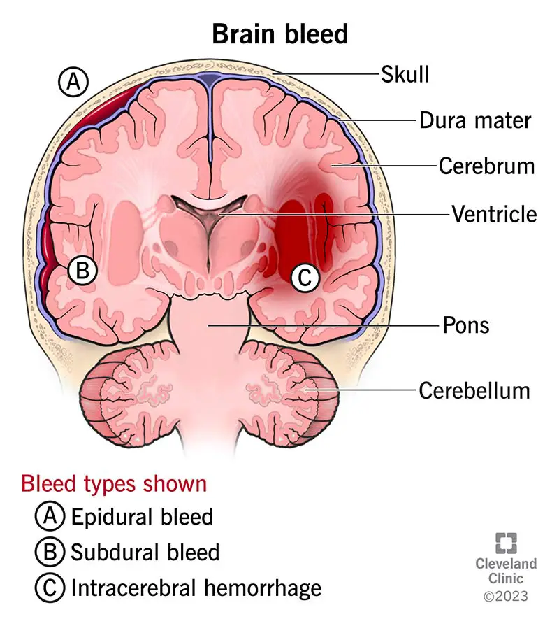 14480 brain bleed hemorrhage intracranial hemorrhage