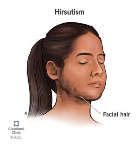 14523 hirsutism