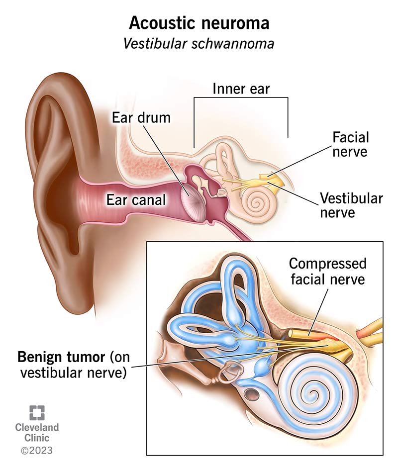 16400 acoustic neuroma