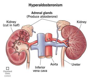 16448 hyperaldosteronism illustration