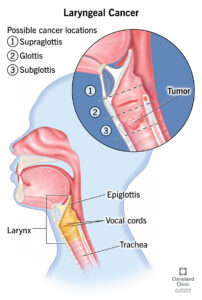 16611 laryngeal cancer