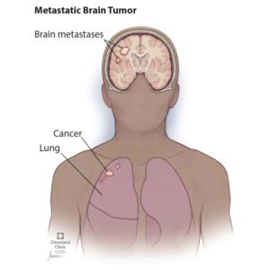 17225 metastatic brain tumor