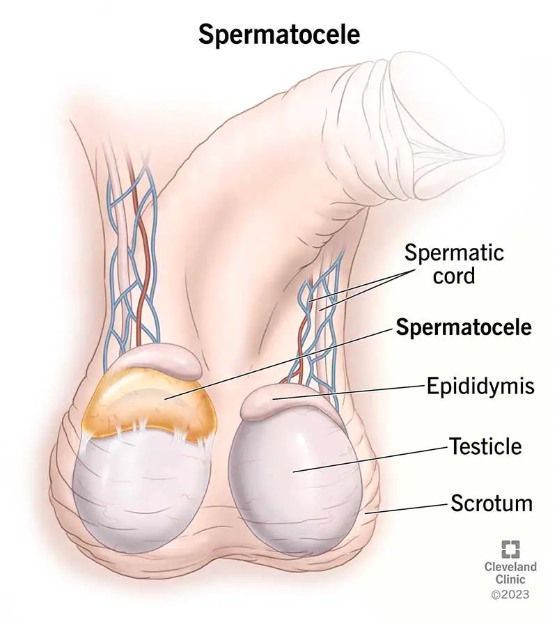 17492 spermatocele