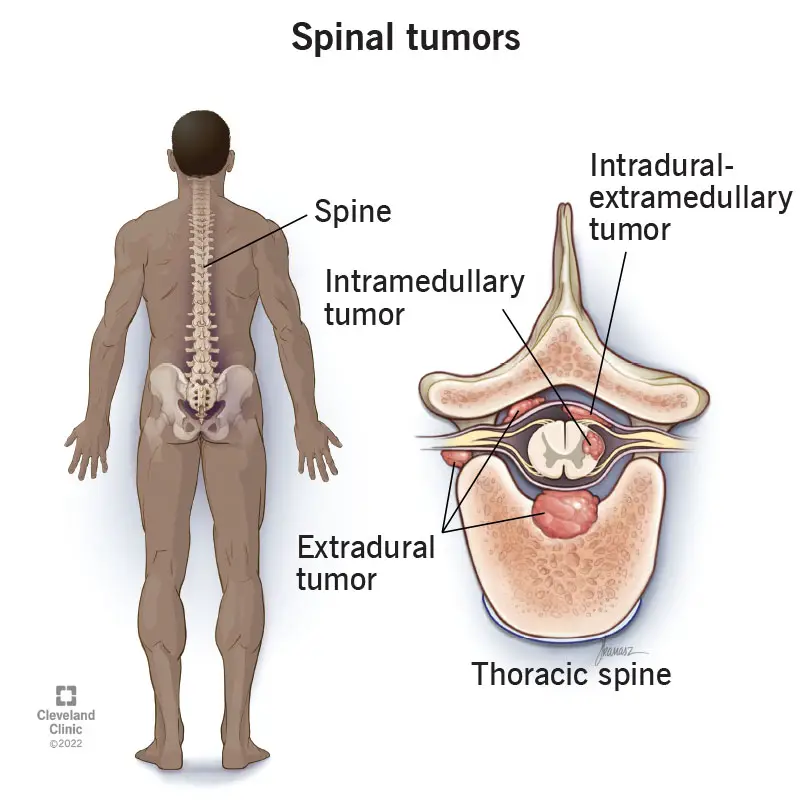 17500 spinal tumors