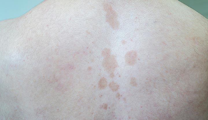 Tinea versicolor žmogaus viršutinės nugaros dalies viduryje.