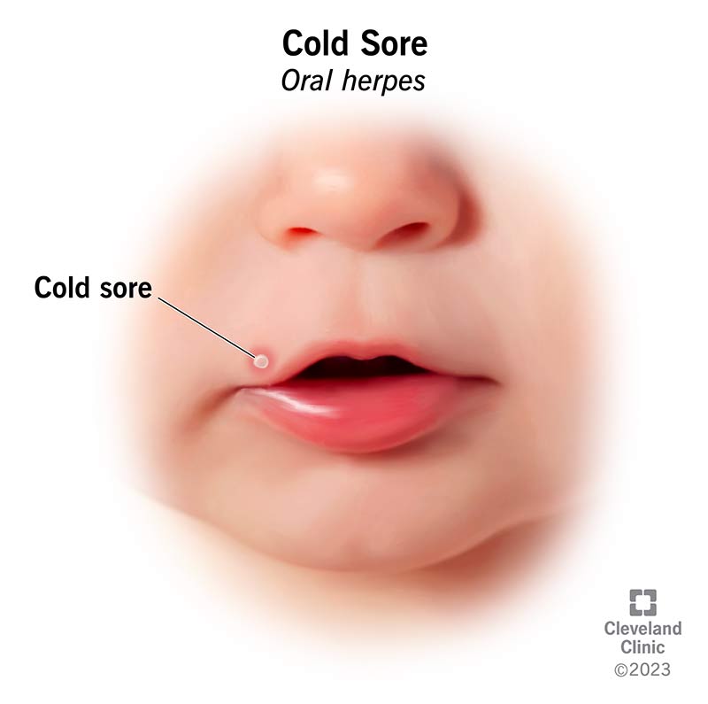 21136 cold sore