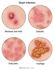 21165 staph infection