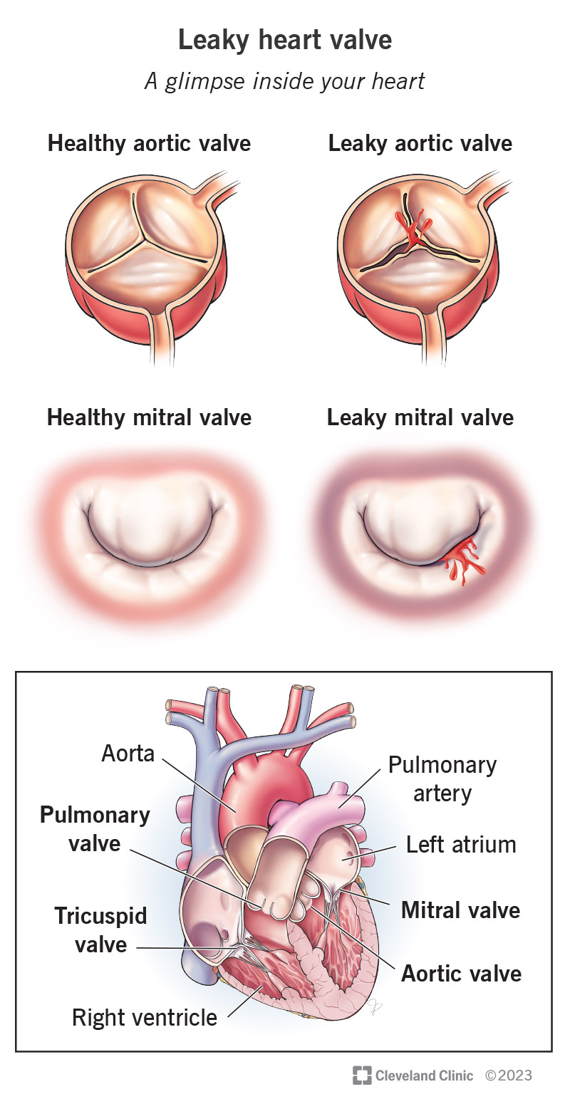 Iliustracijų rinkinys, rodantis skirtumą tarp sveiko širdies vožtuvo ir nesandarios širdies vožtuvo.  Diagrama rodo kiekvieno iš keturių širdies vožtuvų vietą.