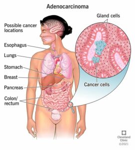 21652 adenocarcinoma