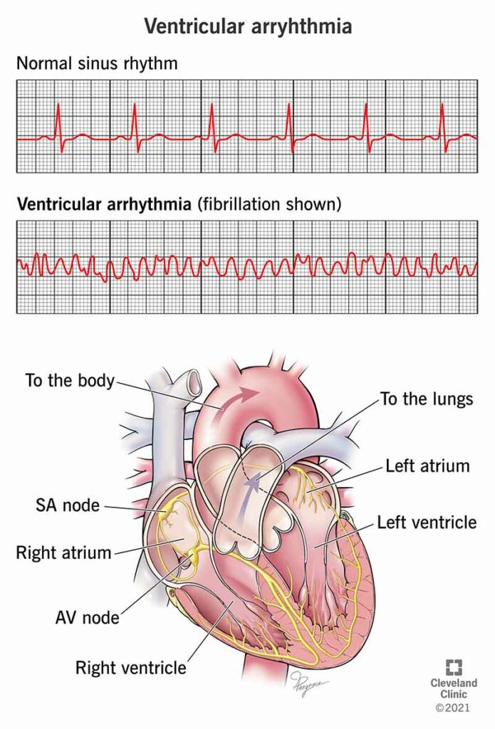 21854 ventricular arrhythmia illustration