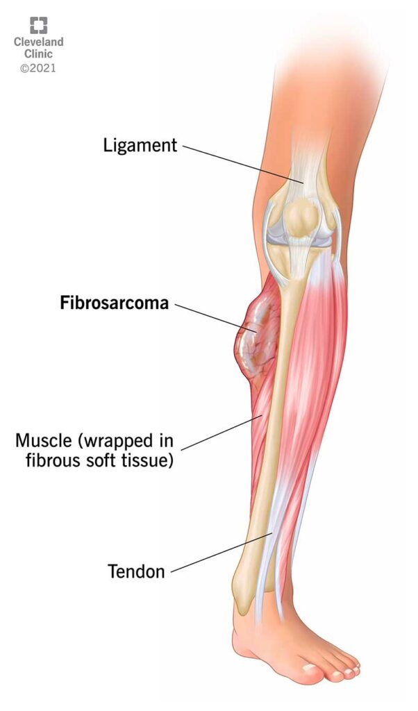 22009 fibrosarcoma