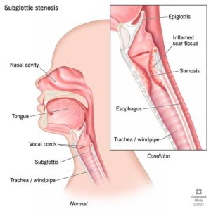 22031 subglottic stenosis illustration