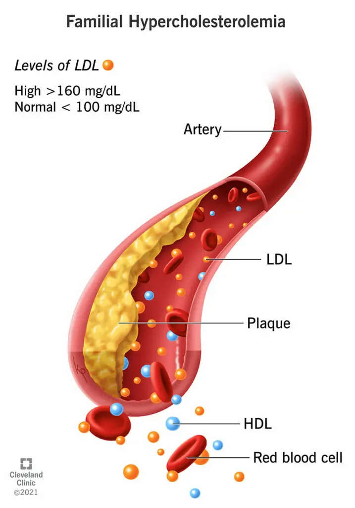 22067 familial hypercholesterolemia illustration